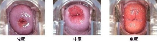 宫颈糜烂