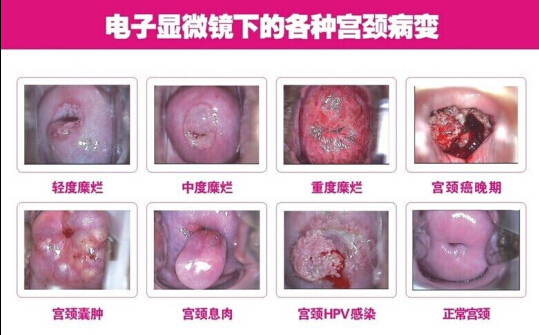 宫颈糜烂