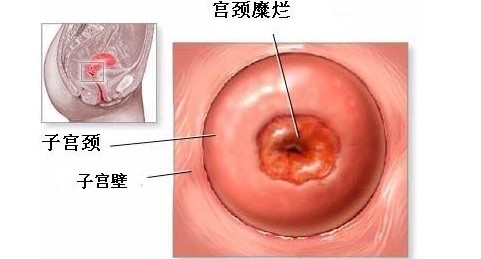 宫颈糜烂